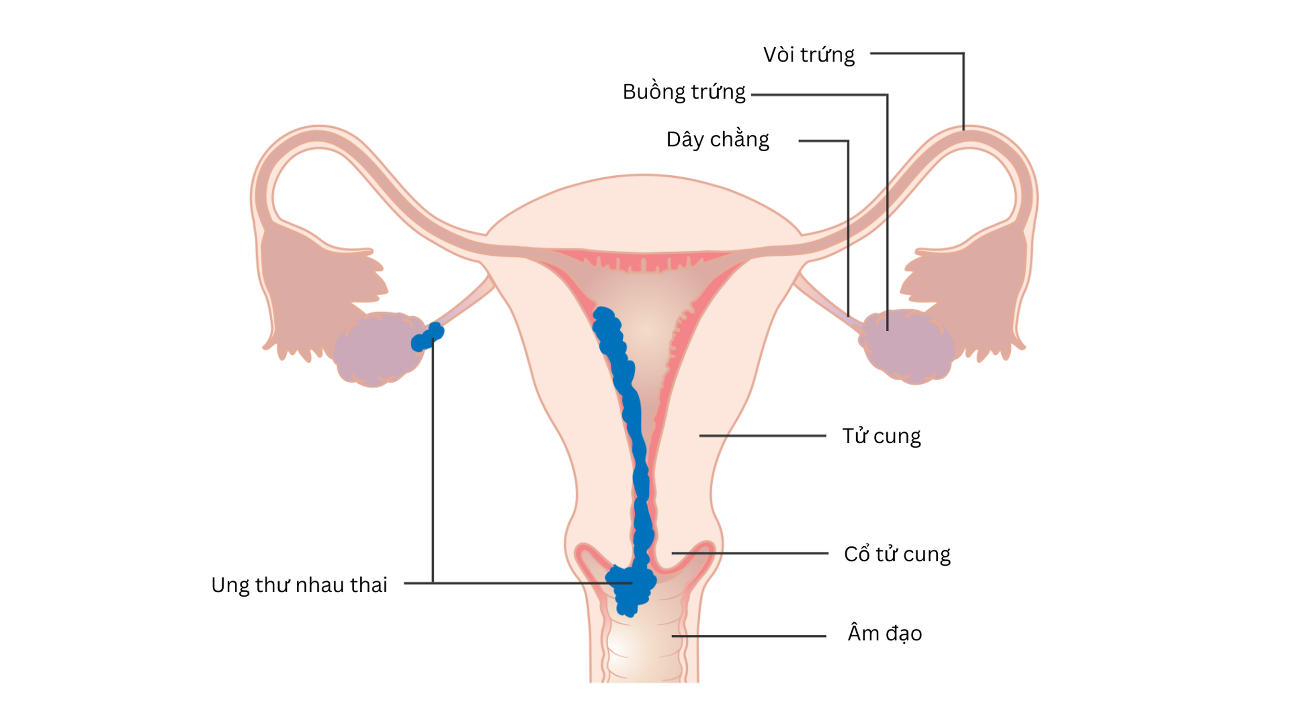 Hình ảnh tế bào ung thư nhau thai