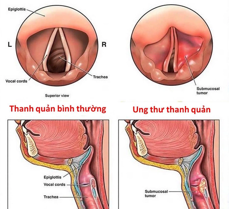 Ung thư thanh quản và đờm ra máu