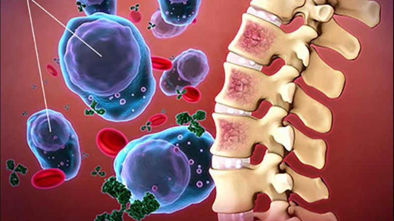 Chẩn đoán ung thư tủy sống qua MRI