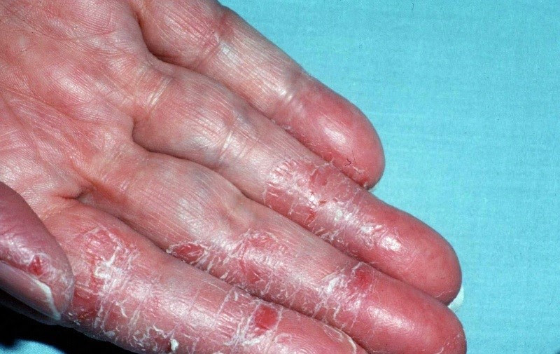 Triệu chứng á sừng đầu ngón tay