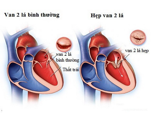 Hẹp van hai lá