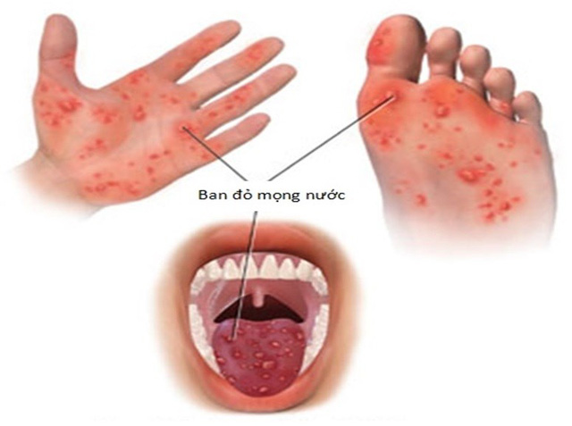 Trẻ bị bệnh tay chân miệng với phát ban đặc trưng trên tay và chân