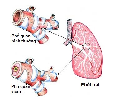 Triệu chứng viêm phế quản cấp