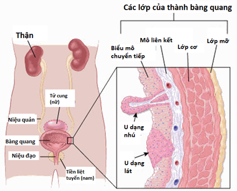 Ung thư bàng quang là gì? 8 Hình ảnh X-quang cho thấy khối u bàng quang
