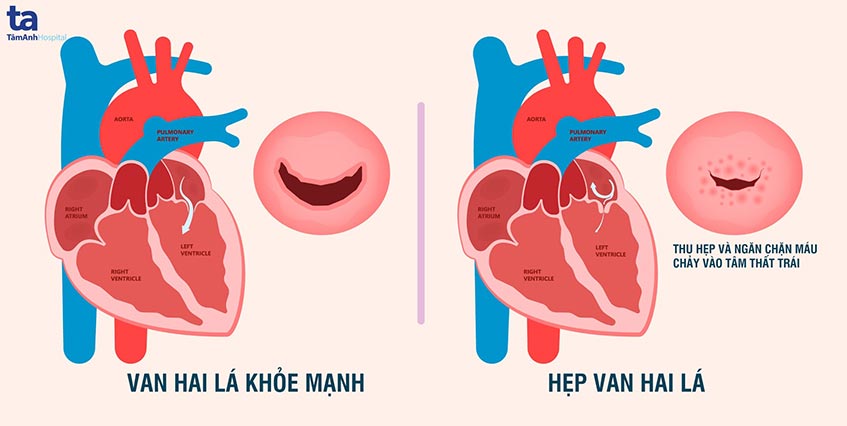 van hai lá bị hẹp