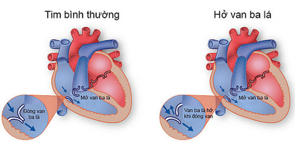 Cấu trúc van ba lá bình thường và bất thường