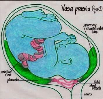 Vasa previa (Mạch máu tiền đạo): Nguy cơ tiềm ẩn trong thai kỳ 7 Siêu âm phát hiện Vasa previa