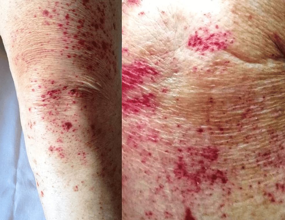 Viêm mạch máu tổng quan