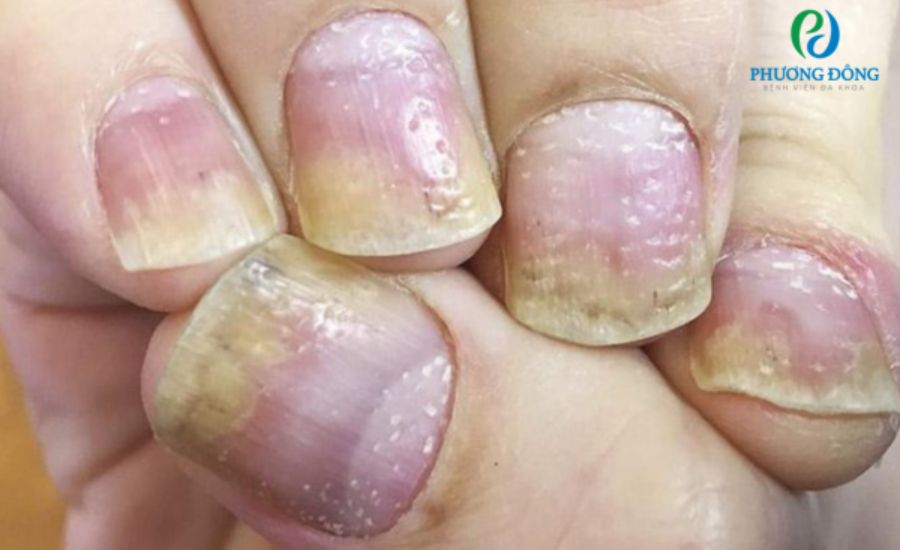 móng tay bị rỗ do vảy nến