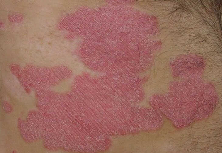 Biểu hiện vảy nến thể mảng trên da đầu