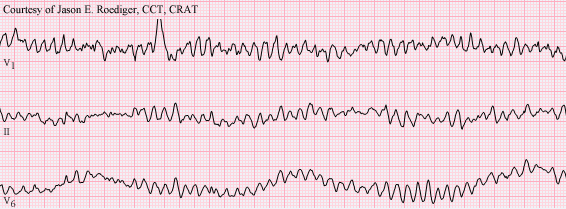 ECG xoắn đỉnh