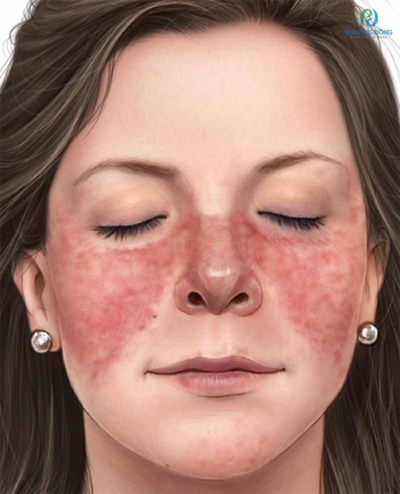 Triệu chứng ban đỏ lupus điển hình