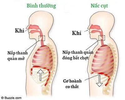 Cơ chế gây nấc cụt