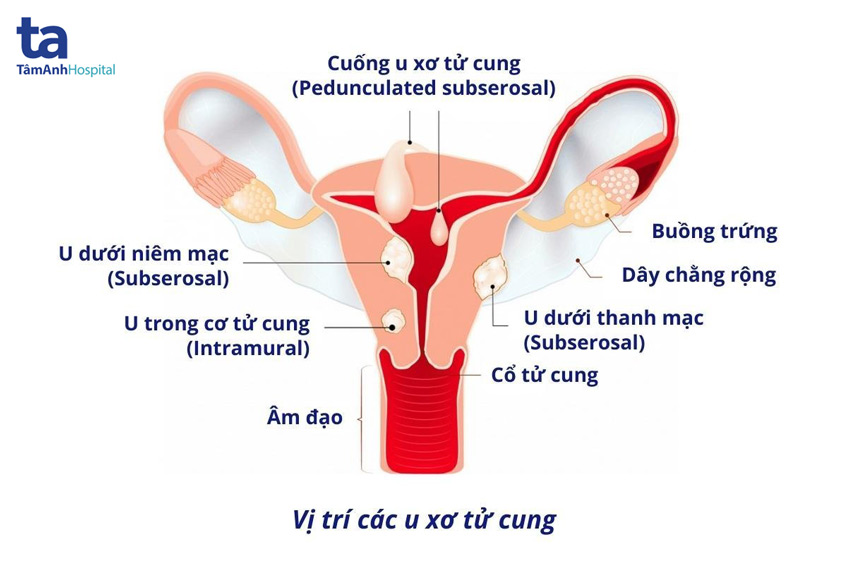 cấu trúc tử cung và khối u xơ