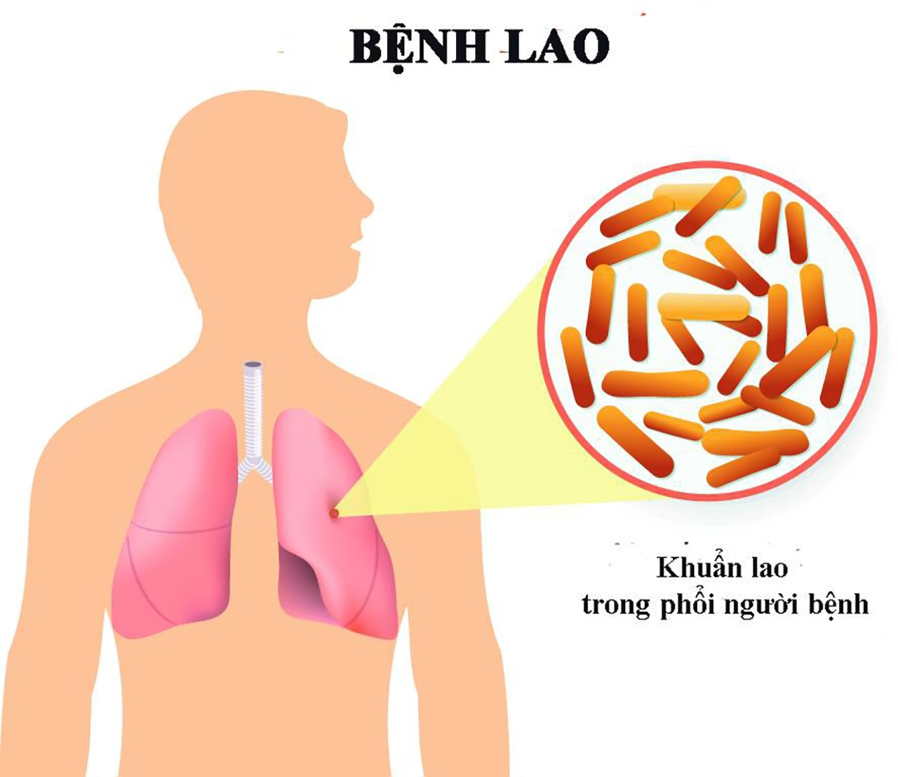 Vi khuẩn lao trong phổi người bệnh
