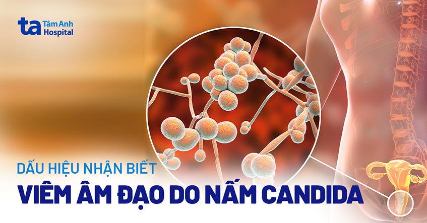 Biểu hiện viêm âm đạo do nấm