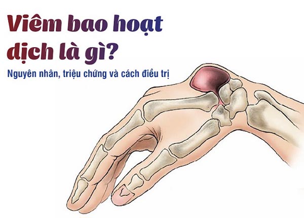 Viêm bao hoạt dịch là gì