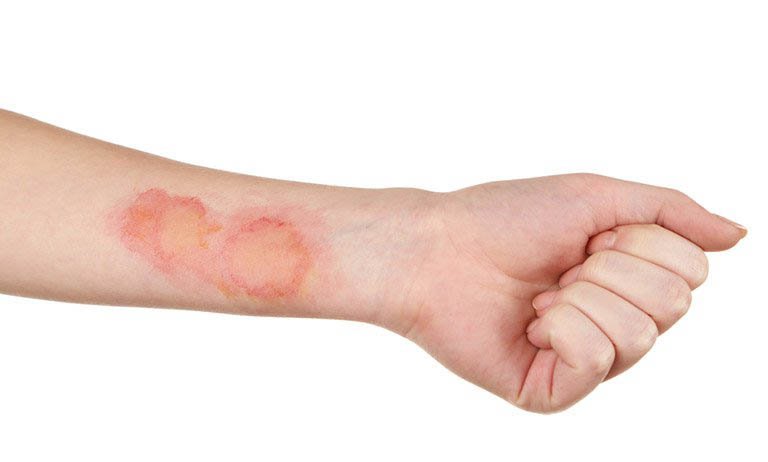 Hình ảnh viêm cơ nhiễm khuẩn