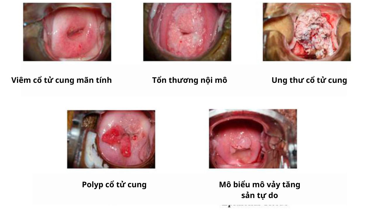 Hình ảnh viêm cổ tử cung do vi khuẩn