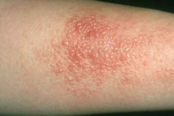 Triệu chứng viêm da dị ứng ở trẻ em