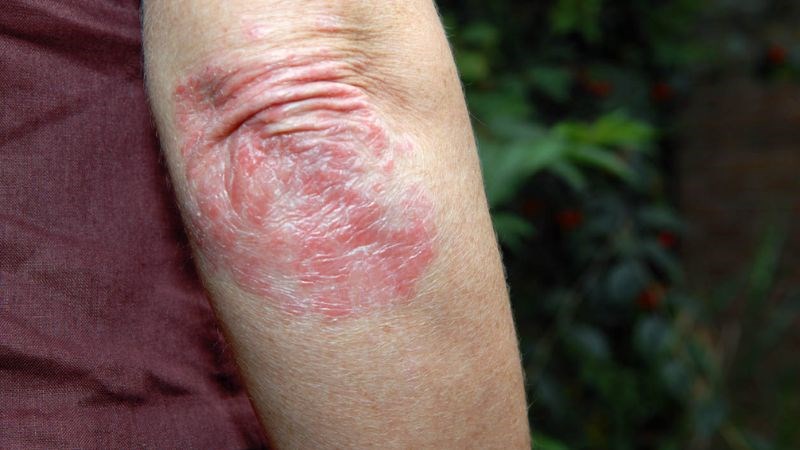 Tổn thương da điển hình viêm da thần kinh