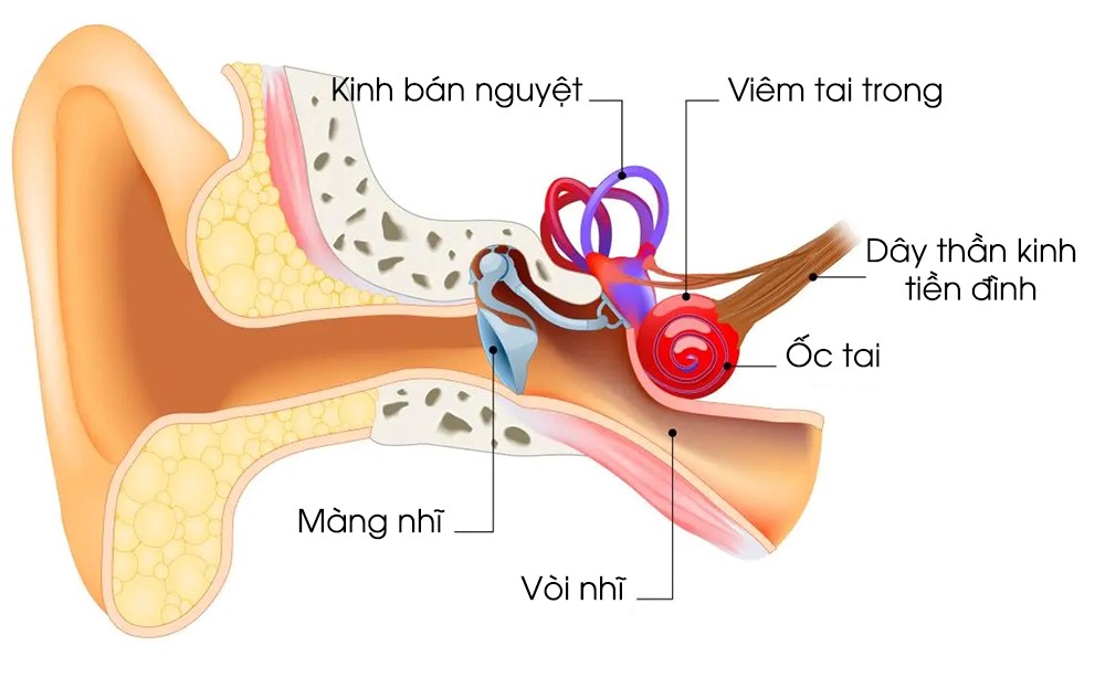 Hình ảnh minh họa viêm thần kinh tiền đình
