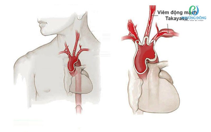 Triệu chứng viêm động mạch Takayasu
