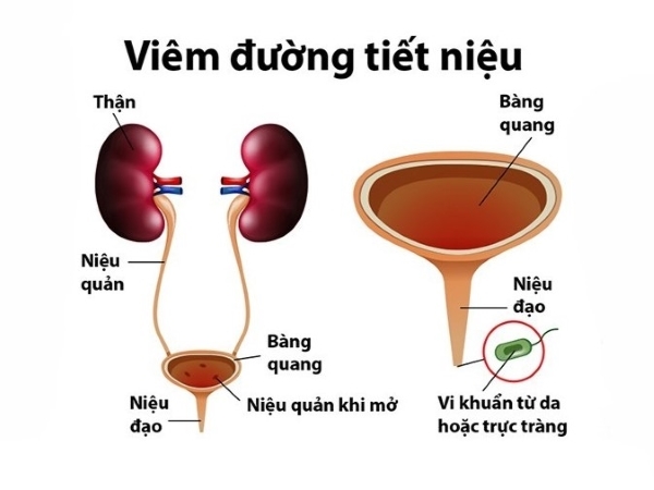 Viêm đường tiết niệu ở phụ nữ
