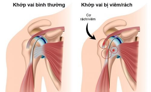 Triệu chứng viêm gân nhị đầu