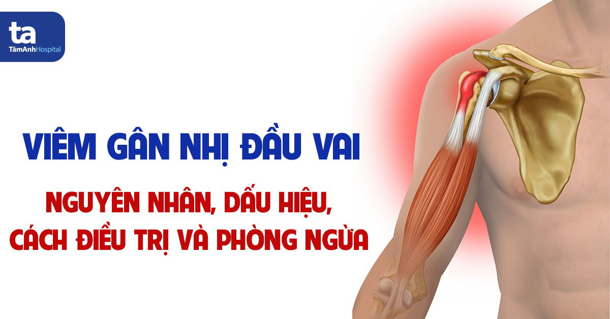 Vị trí gân nhị đầu bị viêm