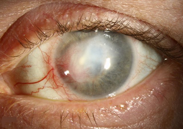 Nhiễm Microsporidia: Vi nấm ký sinh nội bào đe dọa người suy giảm miễn dịch 8 Viêm giác mạc do Microsporidia