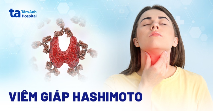 Viêm tuyến giáp Hashimoto