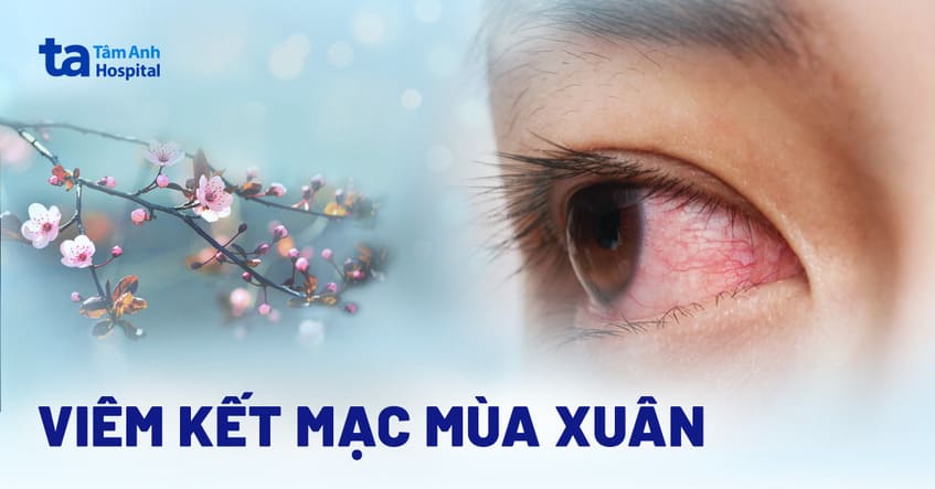Quan sát nhú kết mạc thể nhú khổng lồ