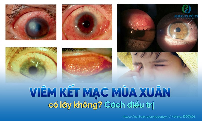 Hình ảnh viêm kết mạc thể nhú khổng lồ