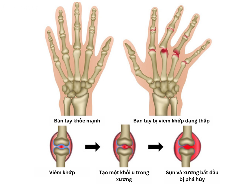 viêm khớp dạng thấp