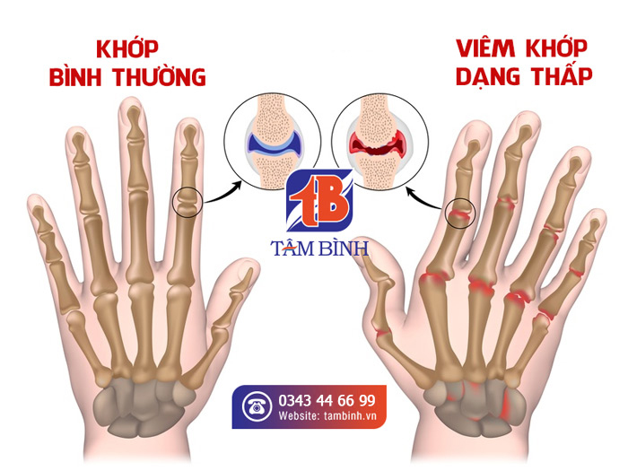 Viêm khớp dạng thấp ở phổi: Biến chứng nguy hiểm ít người biết 7 Viêm khớp dạng thấp ảnh hưởng phổi