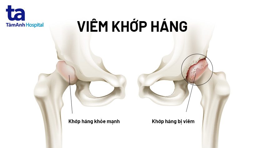 Viêm khớp háng ở trẻ nhỏ