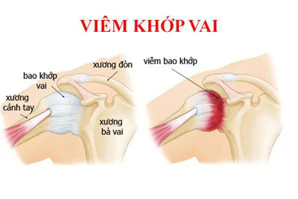 Triệu chứng viêm quanh khớp vai