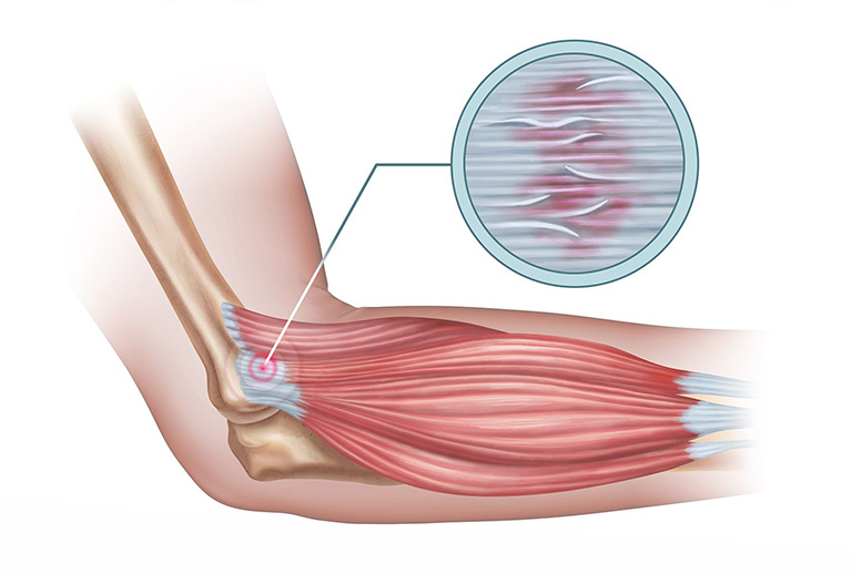 Vị trí đau thường gặp ở Tennis elbow