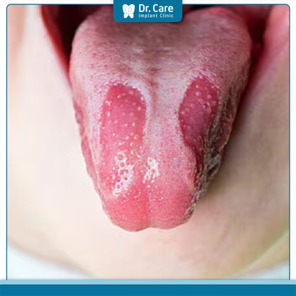 Lưỡi viêm cấp tính