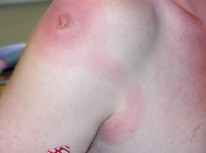 Bệnh viêm mạch bạch huyết phổi ở phụ nữ