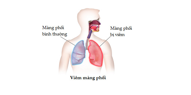 Viêm màng phổi