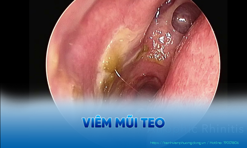 Hình ảnh nội soi niêm mạc mũi bị teo