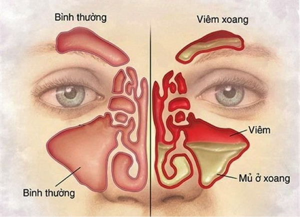 Niêm mạc mũi bị sung huyết