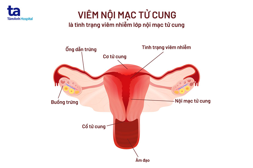Viêm nội mạc tử cung sau sinh