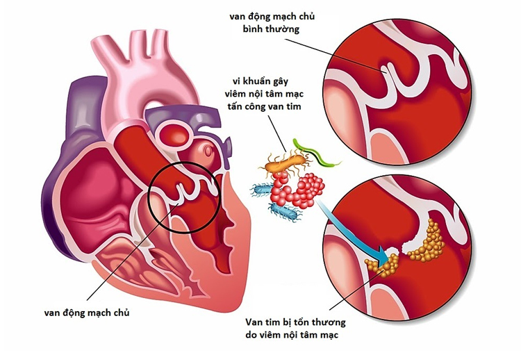 Triệu chứng ngoài tim của viêm nội tâm mạc nhiễm khuẩn