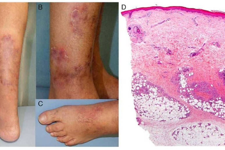 viêm đa động mạch nút triệu chứng