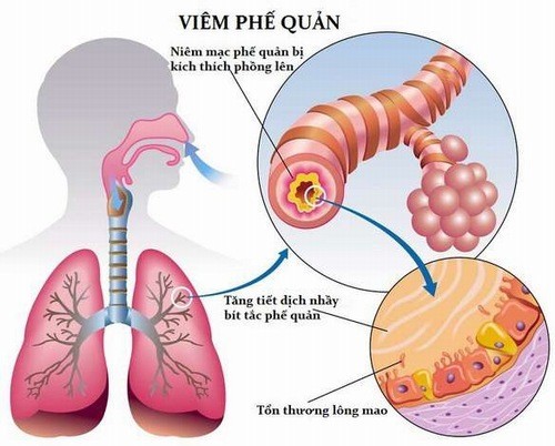 Triệu chứng viêm phế quản co thắt