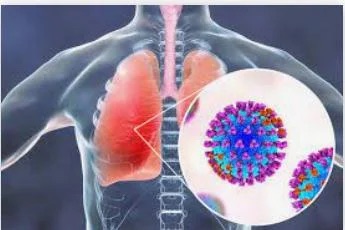 Ảnh chụp CT ngực bệnh nhân viêm phổi ái toan