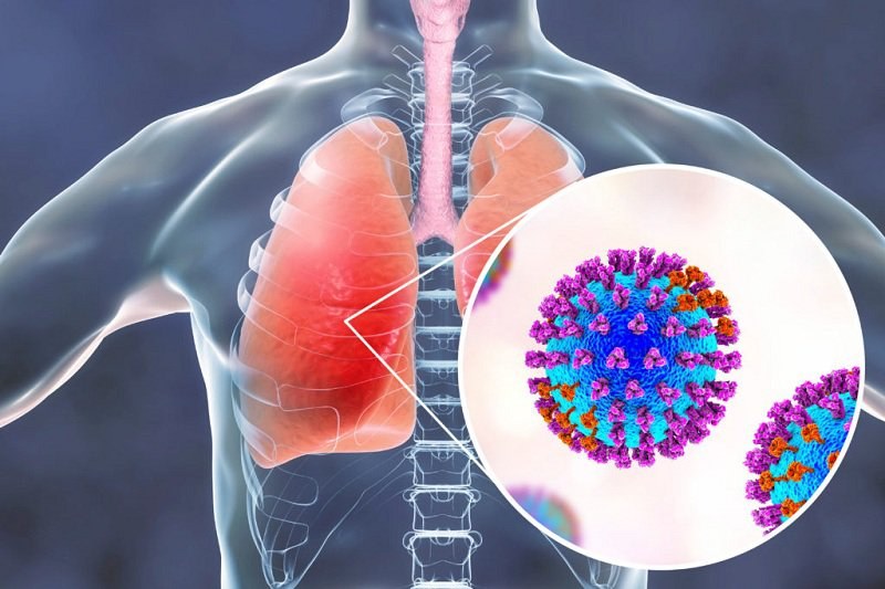 Viêm Phổi Do Vi Khuẩn: Nguyên Nhân, Triệu Chứng, Chẩn Đoán và Điều Trị 8 Triệu chứng viêm phổi do vi khuẩn